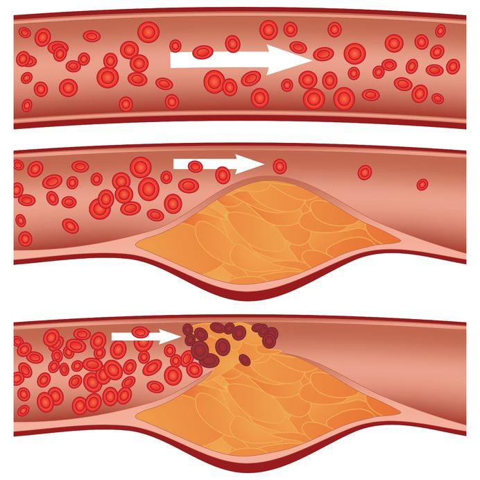 cholesterin