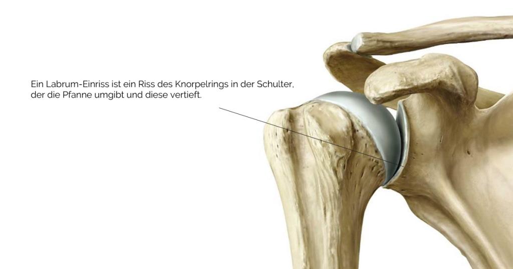 Labrumriss in der rechten Schulter christine scheyer labrumriss rechte schulter
